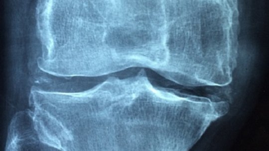 Osteoartrita: ce tratamente sunt recomandate?