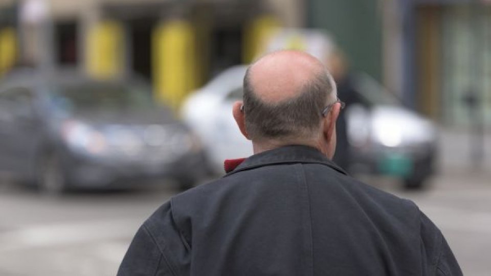 Alopecia sau căderea părului: Semne de alarmă