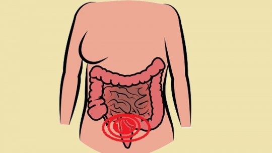 Screening pentru depistarea cancerului de colon