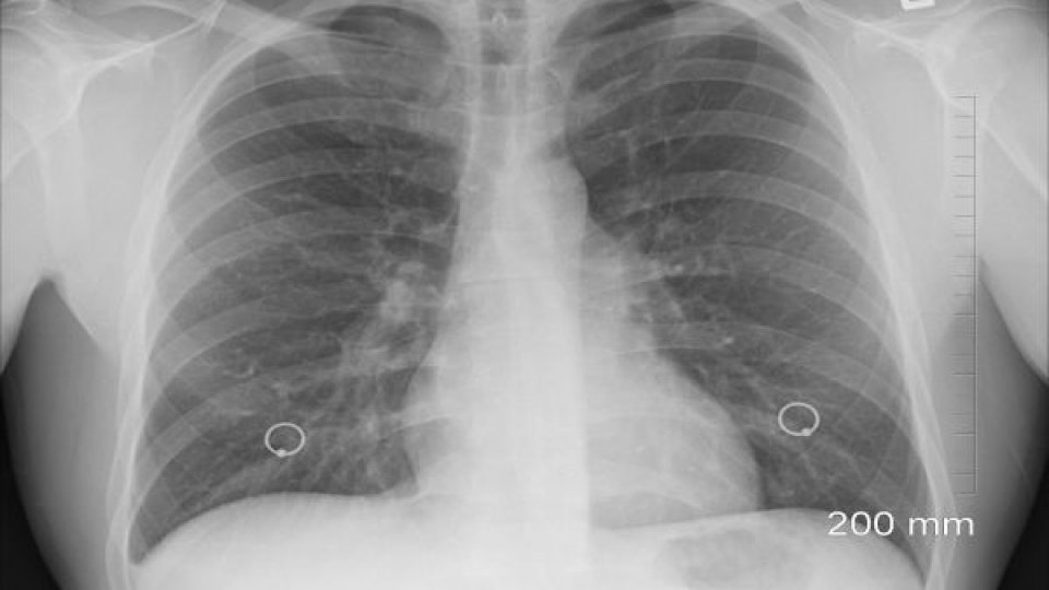 Boala pulmonară obstructivă cronică, o afecțiune medicală gravă