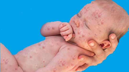 Peste 96% din cazurile de rujeolă sunt persoane nevaccinate