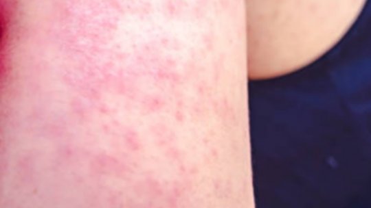 Aproape 450 de cazuri de rujeolă au fost raportate, în ultima săptămână, în 34 de judeţe şi în capitală