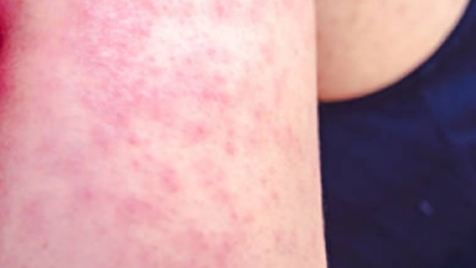 Aproape 450 de cazuri de rujeolă au fost raportate, în ultima săptămână, în 34 de judeţe şi în capitală