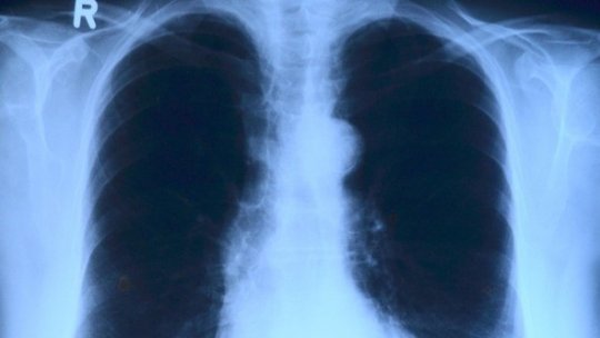 Numărul bolnavilor de tuberculoză la nivel mondial este în creştere