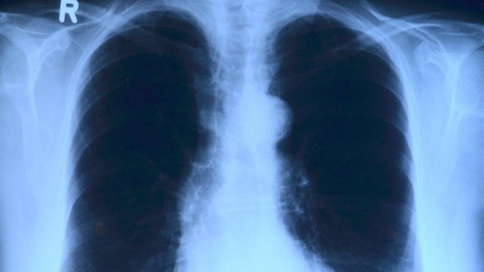 Numărul bolnavilor de tuberculoză la nivel mondial este în creştere