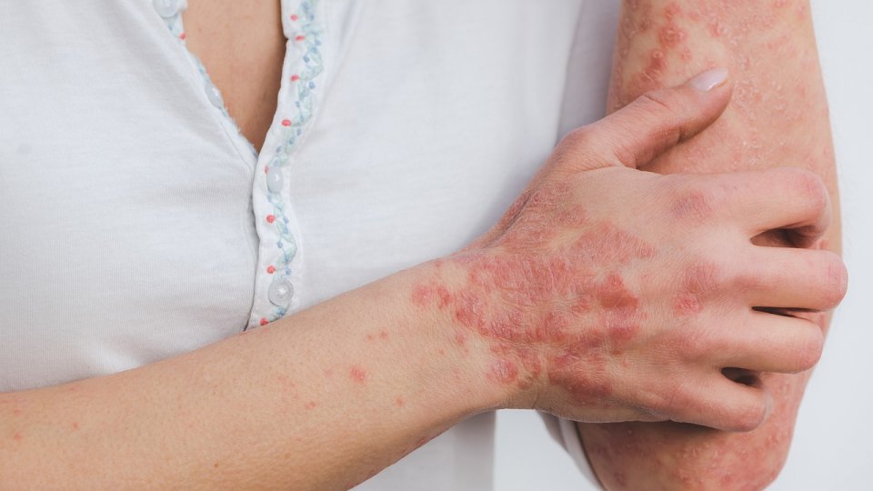 Psoriazis: pierderea în greutate este benefică