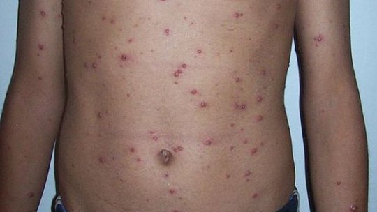 Preşedintele CNAS: Suntem în epidemie de rujeolă, soluţia rămâne vaccinarea