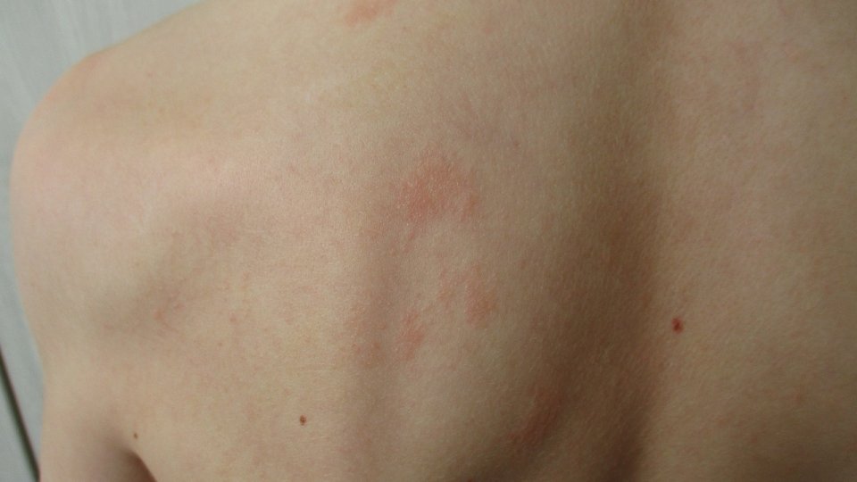 Urticaria - ce este și cum se tratează?