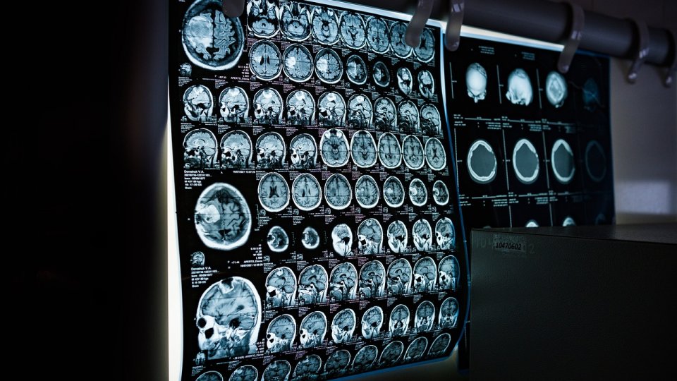 Cum recunoști o criză de epilepsie?