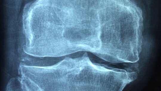 Reumatism: pași mici pentru ameliorarea artritei și osteoartritei