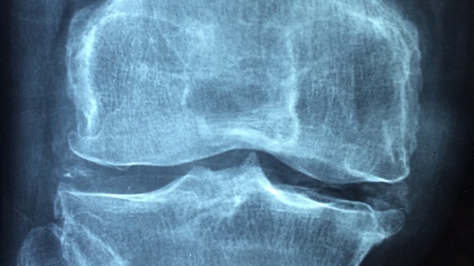 Reumatism: pași mici pentru ameliorarea artritei și osteoartritei