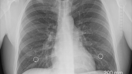 Tuberculoza: 7 semne de avertizare
